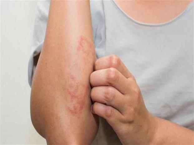 درجات الحرارة المرتفعة في الصيف سببٌ في حدوث سرطان الجلد